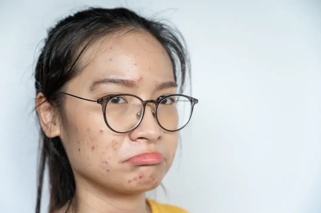 Bật Mí Bí Quyết Trị Mụn Bọc Ở Má Nhanh Chóng, Ngừa Thâm Sẹo 1 6 e1757573887757