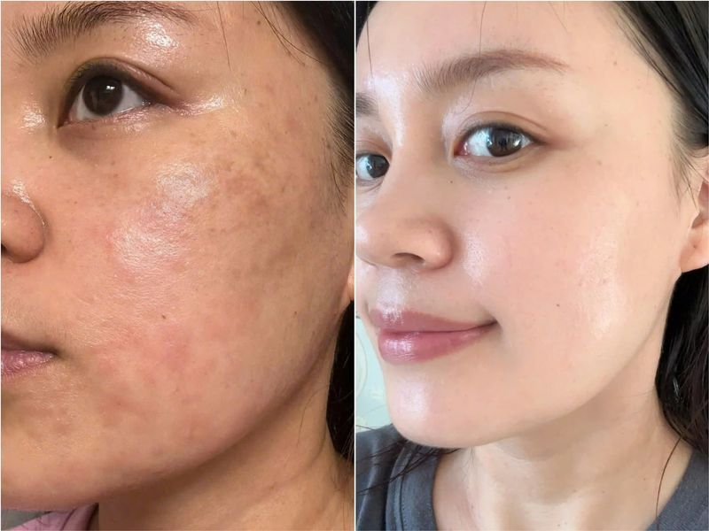 Trước và sau khi sử dụng Combo Huyết thanh Glutathione vs Kem Dưỡng Melatonin Liposome (ảnh minh hoạ)