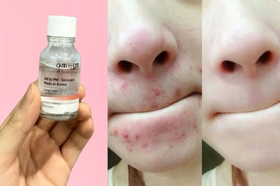 Trị mụn viêm