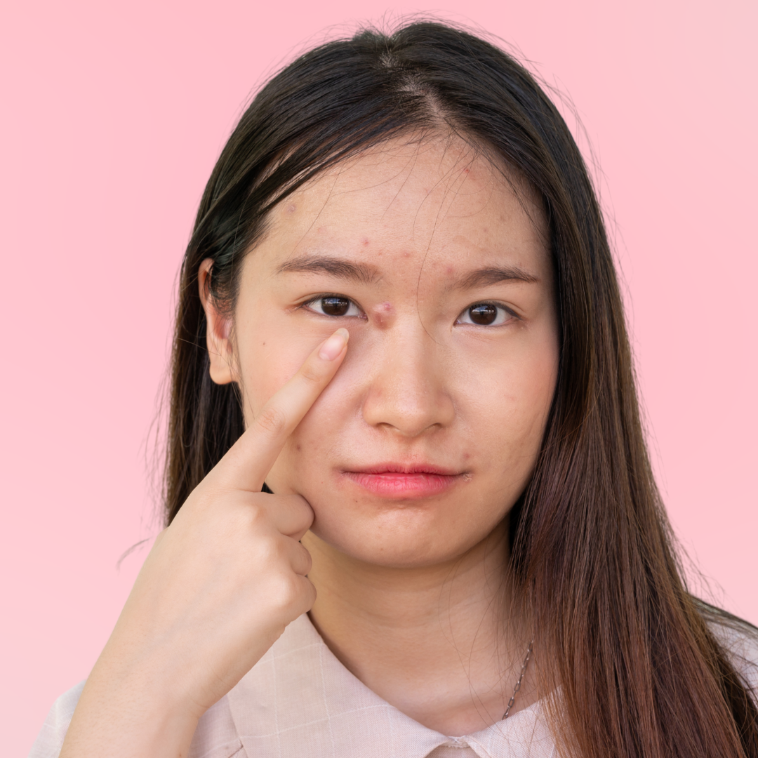 mụn viêm không nhân